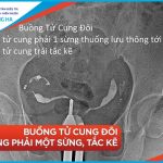 Chụp tử cung vòi trứng: Chẩn đoán & điều trị bệnh tử cung và vòi trứng.