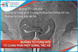 Chụp tử cung vòi trứng: Chẩn đoán & điều trị bệnh tử cung và vòi trứng.