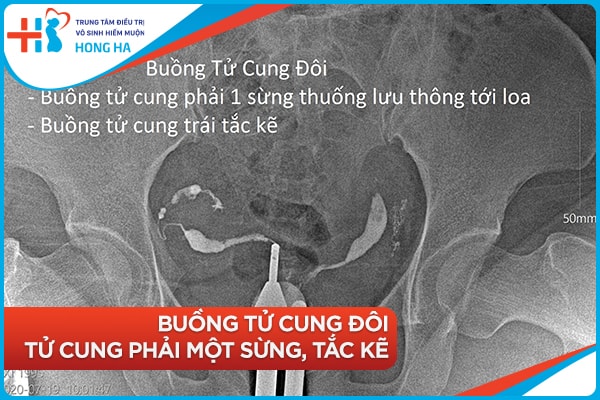 Chụp tử cung vòi trứng: Chẩn đoán & điều trị bệnh tử cung và vòi trứng.