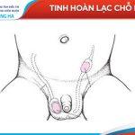 Tình trạng tinh hoàn lạc chỗ ở nam giới: Nguyên nhân và cách điều trị