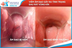 Những nguyên nhân và cách điều trị viêm âm đạo hiệu quả