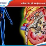 Triệu chứng, nguyên nhân và cách điều trị viêm đài bể thận