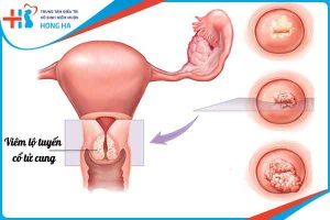 Viêm lộ tuyến cổ tử cung: Dấu hiệu và cách điều trị qua các cấp độ bệnh