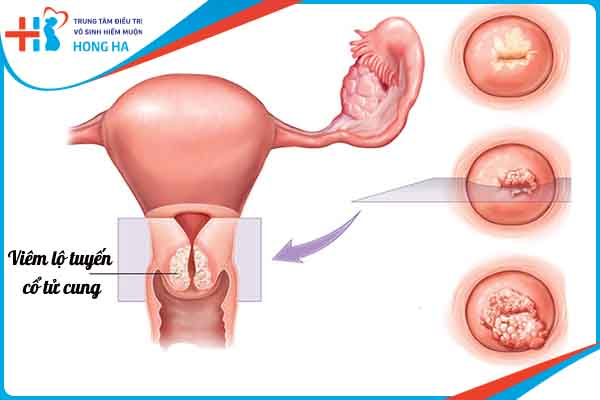 Viêm lộ tuyến cổ tử cung: triệu chứng và cách điều trị hiệu quả 85%