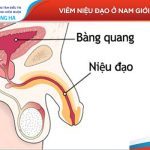 Viêm niệu đạo nam ở nam giới: Nguyên nhân, triệu chứng, cách điều trị