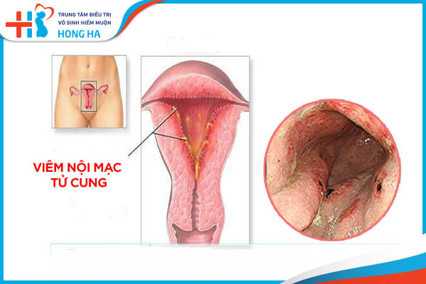 Viêm nội mạc tử cung: Nguyên nhân, triệu chứng và phương pháp điều trị