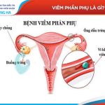 Các bước để phòng ngừa viêm phần phụ và duy trì sức khỏe phụ nữ