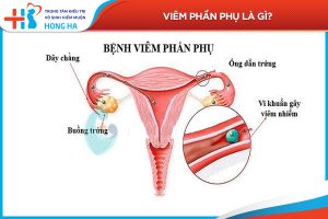 Các bước để phòng ngừa viêm phần phụ và duy trì sức khỏe phụ nữ