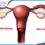 Cách phòng ngừa viêm vòi trứng tốt nhất cho phụ nữ
