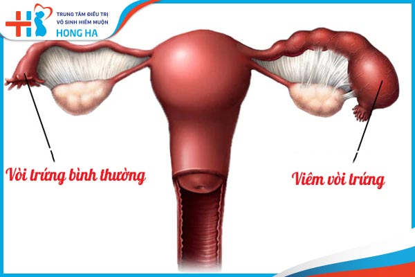 Cách phòng ngừa viêm vòi trứng tốt nhất cho phụ nữ