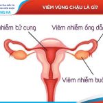 Viêm vùng chậu – Nguyên nhân và cách điều trị để giảm 80% nguy cơ tái phát