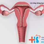 Vòi trứng thông hạn chế : Nguyên nhân và phương pháp điều trị 75%