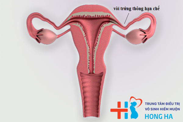 Vòi trứng thông hạn chế : Nguyên nhân và phương pháp điều trị 75%