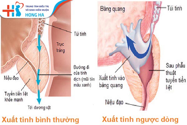 Rối loạn xuất tinh ở nam giới: Nguyên nhân, triệu chứng và cách điều trị