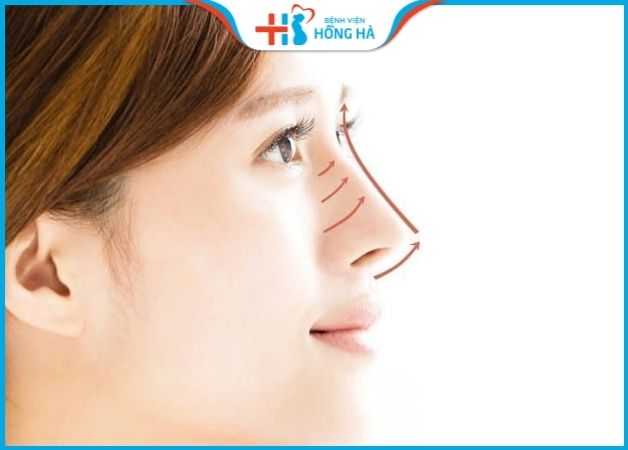 Phẫu thuật nâng mũi kết hợp nắn chỉnh hình xương mũi cho kết quả hoàn hảo