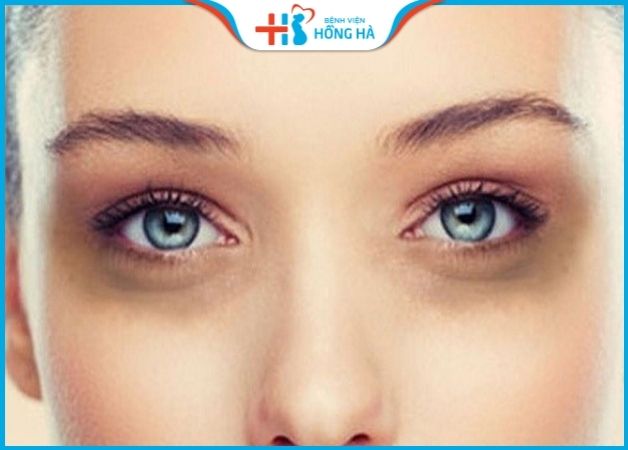 Quầng mắt xuất hiện chủ yếu xuất phát từ sự mệt mỏi của cơ thể.