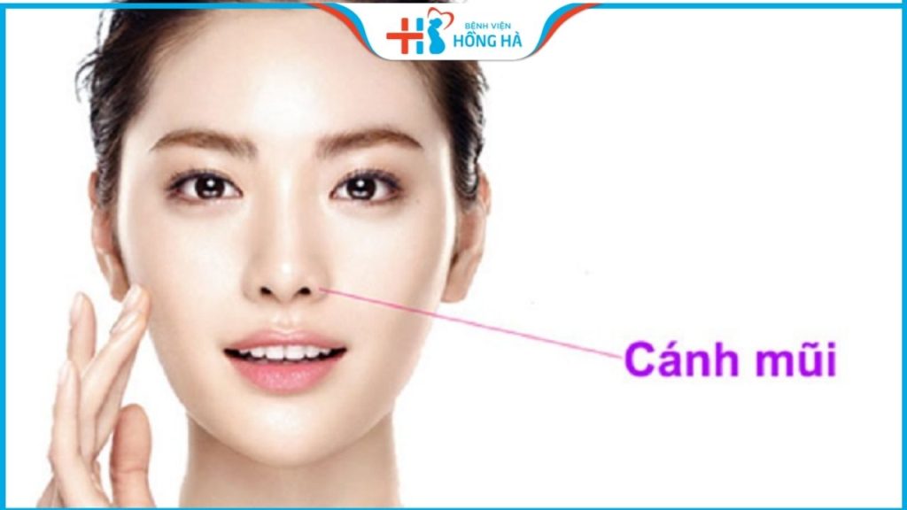 Cắt cánh mũi giá bao nhiêu? Có đắt không? Giữ vĩnh viễn không?