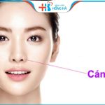 Cắt cánh mũi giá bao nhiêu? Có đắt không? Giữ vĩnh viễn không? 