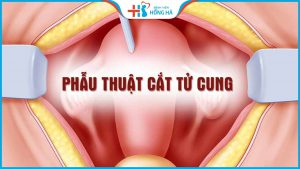 Chi phí mổ cắt tử bao nhiêu? Bảng giá cắt tử cung tại Hồng Hà
