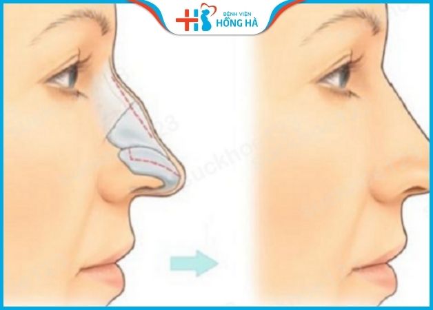 Dựa vào từng tình trạng mũi cụ thể, bác sĩ áp dụng kỹ thuật chỉnh mũi phù hợp