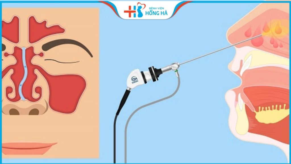 Chỉnh vách ngăn mũi bao nhiêu tiền? Quy trình và lưu ý khi phẫu thuật