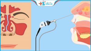 Chỉnh vách ngăn mũi bao nhiêu tiền? Quy trình và lưu ý khi phẫu thuật