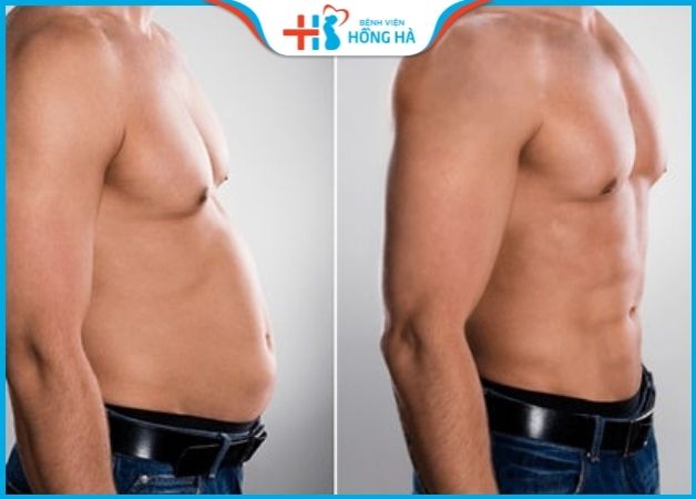 Hút mỡ bụng đàn ông công nghệ cao giảm đến 95% lượng mỡ thừa trong cơ thể