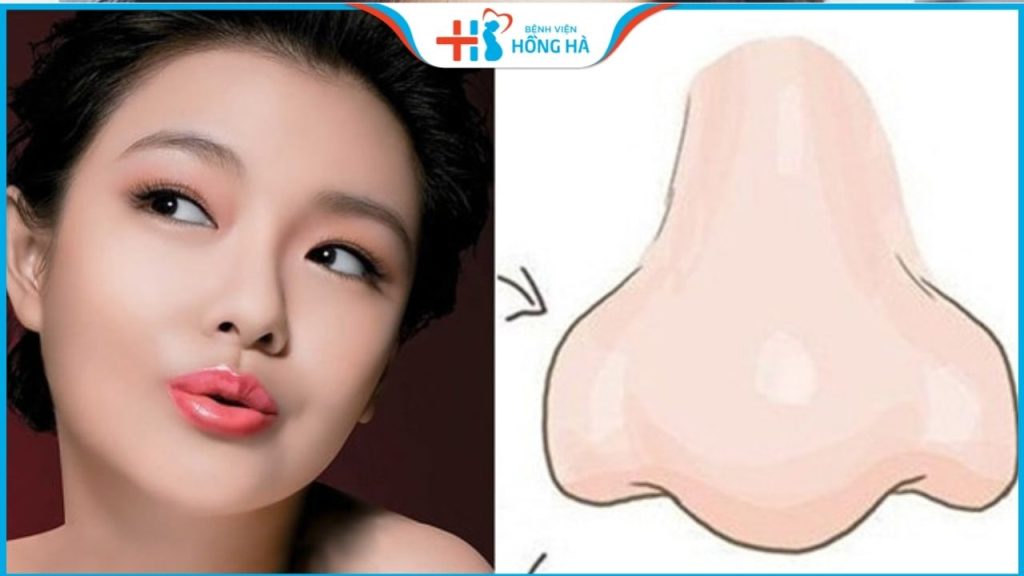8 kỹ thuật nâng mũi đẹp nhất hiện nay – Lưu ý cần biết khi nâng mũi