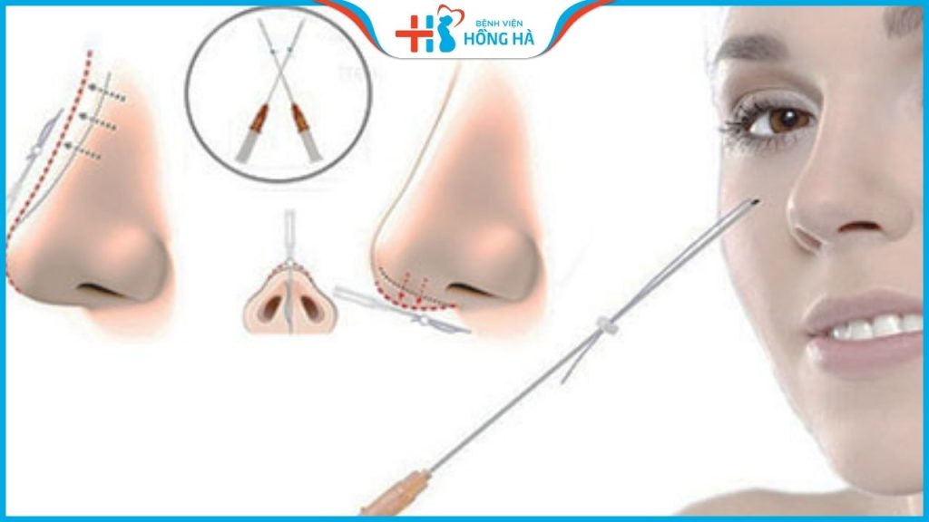 Nâng mũi bằng chỉ collagen là gì? Có tốt không? Hiệu quả bao lâu