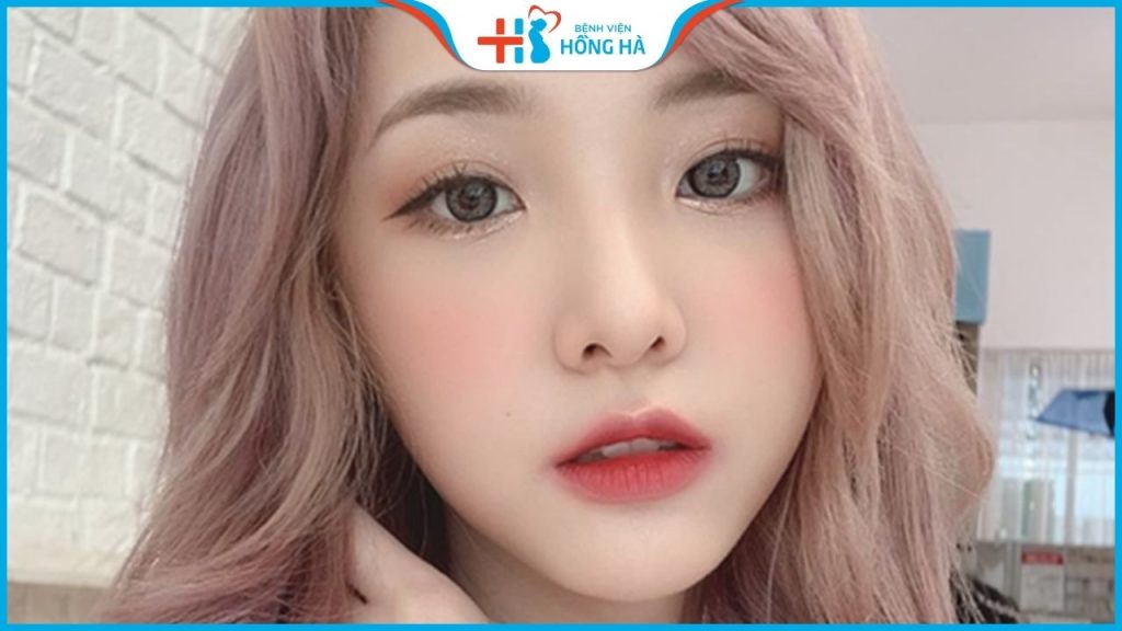 Nâng mũi bọc sụn: Giải pháp mũi đẹp toàn diện, không bóng đỏ lộ sóng