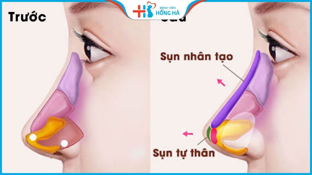 Nâng mũi bọc sụn giá bao nhiêu? Bảng giá trọn gói không phát sinh