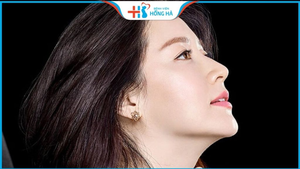 Nâng mũi cấu trúc L Line: Cách tạo hình dáng mũi cao tây hiện đại