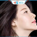 Nâng mũi cấu trúc L Line: Cách tạo hình dáng mũi cao tây hiện đại 
