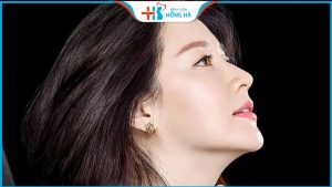 Nâng mũi cấu trúc L Line: Cách tạo hình dáng mũi cao tây hiện đại 