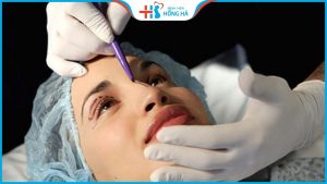 Nâng mũi mất bao lâu? Bao nhiêu ngày thì ổn định? – Bác sĩ trả lời