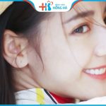 Nâng mũi sụn nhân tạo an toàn không? Cảnh báo 3 sai lầm khi nâng mũi 