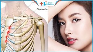 Thế nào là nâng mũi sụn sườn tự thân? Giá bao nhiêu? Vĩnh viễn không?