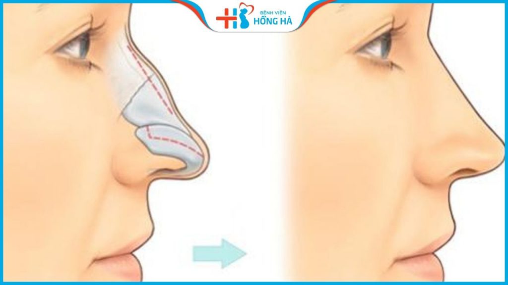 Phẫu thuật nắn chỉnh xương chính mũi – Giải pháp cho mũi gồ, lệch vẹo 