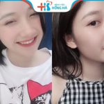 Có nên chỉnh sửa dáng mũi củ tỏi hay không?