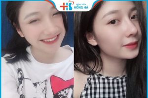 Có nên chỉnh sửa dáng mũi củ tỏi hay không?