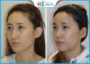 Mũi gãy là như nào? Khắc phục mũi gãy thay đổi tướng số hiệu quả