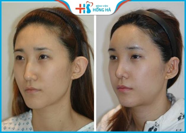 Mũi gãy là như nào? Khắc phục mũi gãy thay đổi tướng số hiệu quả