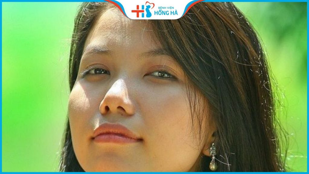 Lỗ mũi hứng hạt mưa là gì? Cách khắc phục lỗ mũi hứng hạt mưa