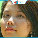 Lỗ mũi hứng hạt mưa là gì? Cách khắc phục lỗ mũi hứng hạt mưa
