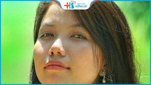 Lỗ mũi hứng hạt mưa là gì? Cách khắc phục lỗ mũi hứng hạt mưa