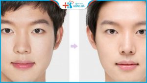 Mũi lệch vẹo: Nguyên nhân, cách nhận biết và tips khắc phục hiệu quả