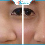 Mũi to do đâu? Cách khắc phục mũi to như thế nào?