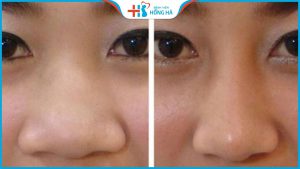 Mũi to do đâu? Cách khắc phục mũi to như thế nào?