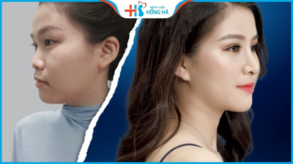 5 Tướng mũi không nên sửa kẻo cuộc đời cơ cực, vận xui kéo đến