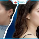 5 Tướng mũi không nên sửa kẻo cuộc đời cơ cực, vận xui kéo đến